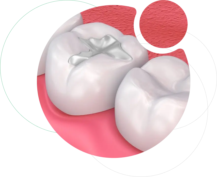 Dental Fillings