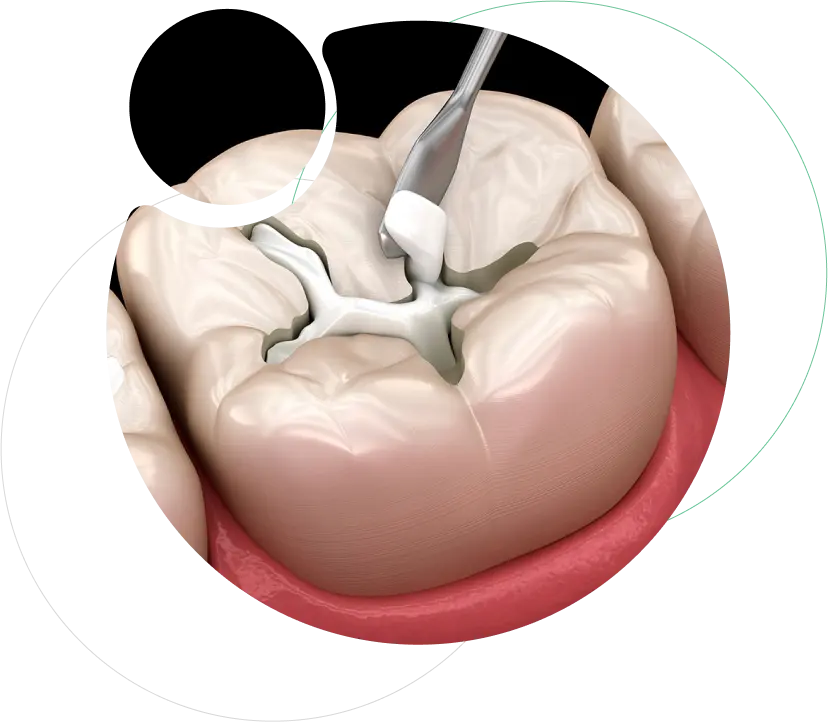 Dental Fillings