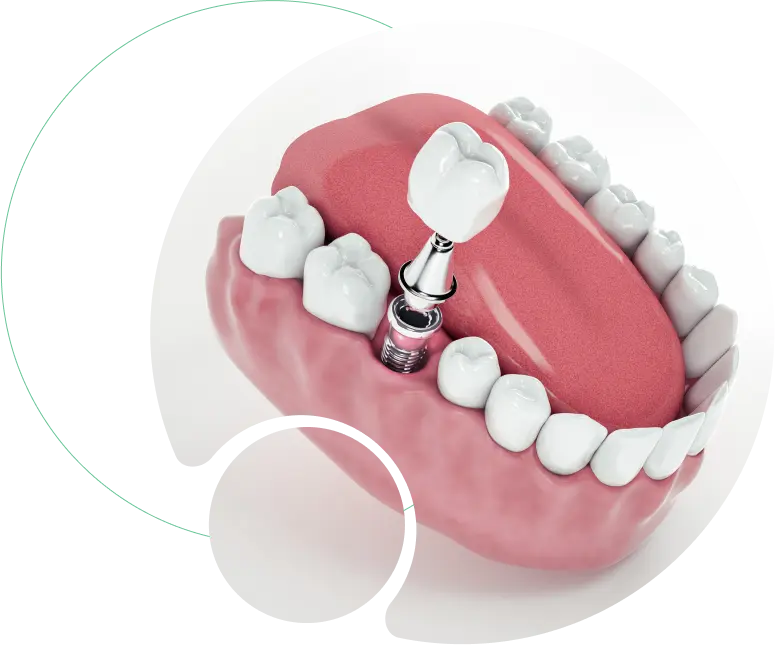 Dental Implants