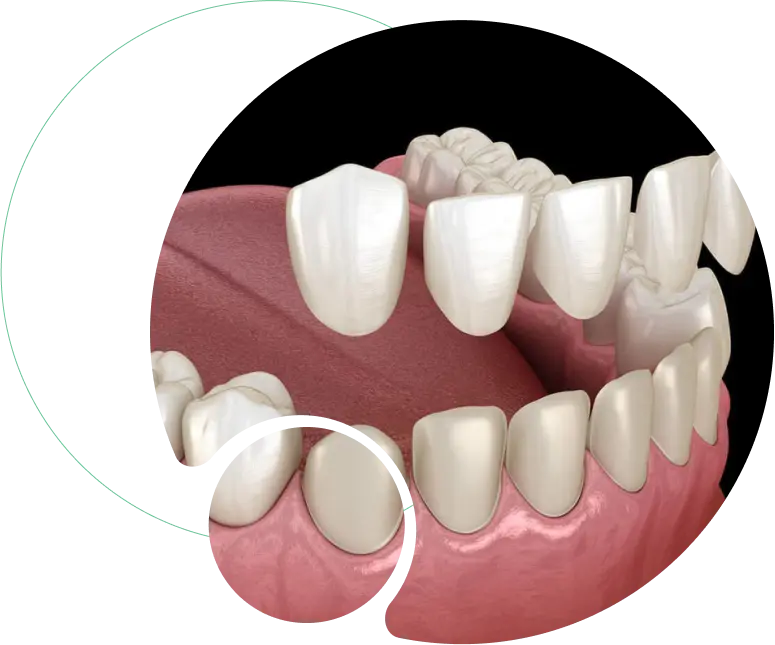 Dental Veneers