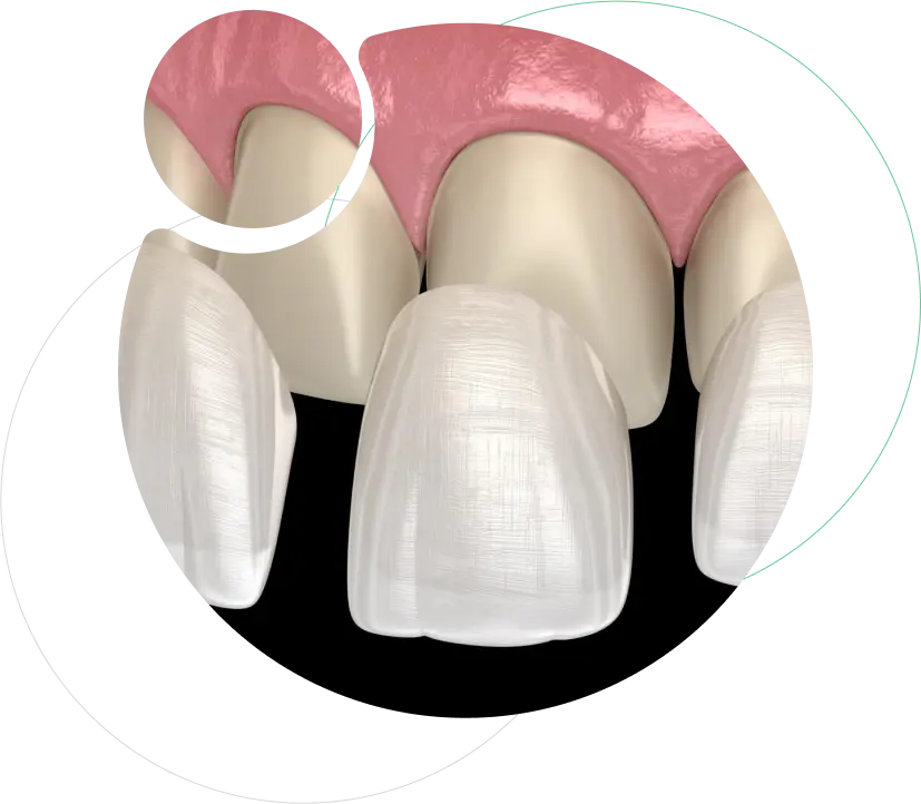 Dental Veneers