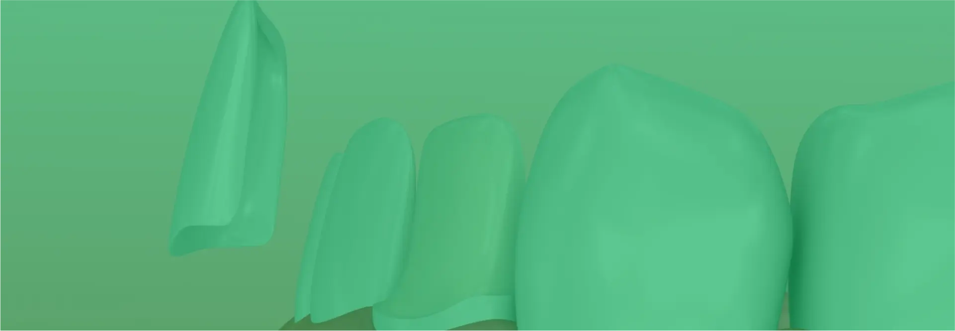 Dental Veneers