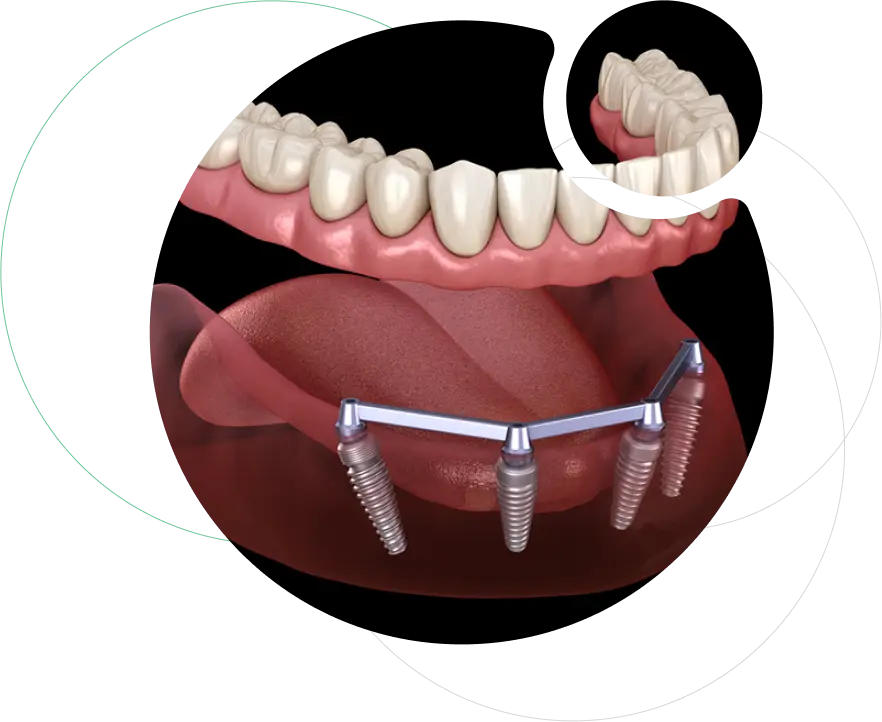 Full Mouth Reconstruction