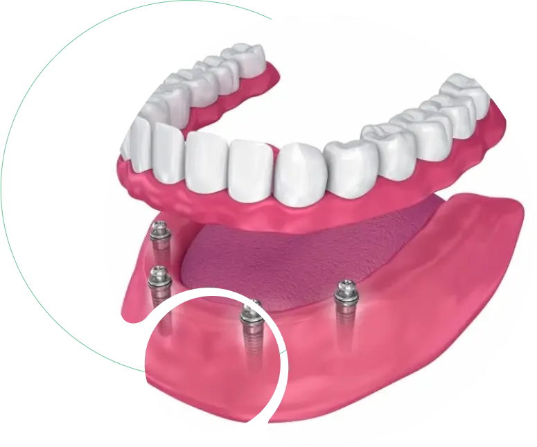 Full Mouth Reconstruction