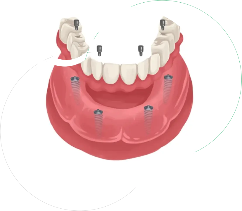 Full Mouth Reconstruction