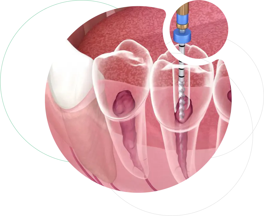 Root Canal Treatment