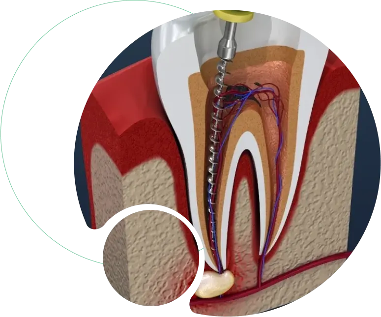 Root Canal Treatment