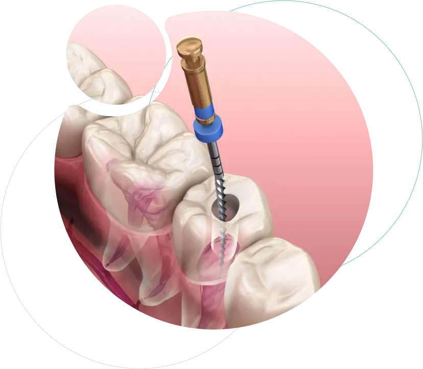 Root Canal Treatment