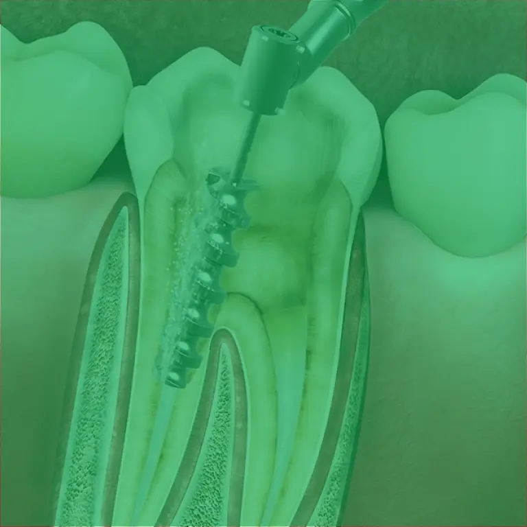 Root Canal Treatment