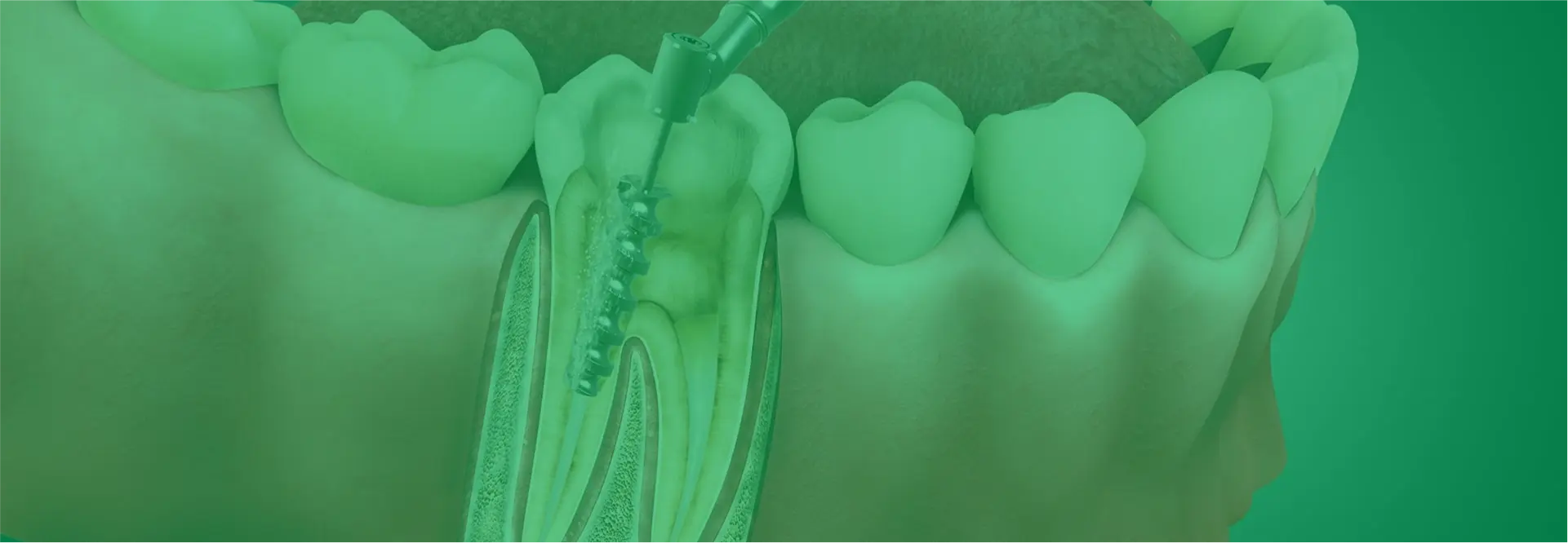 Root Canal Treatment