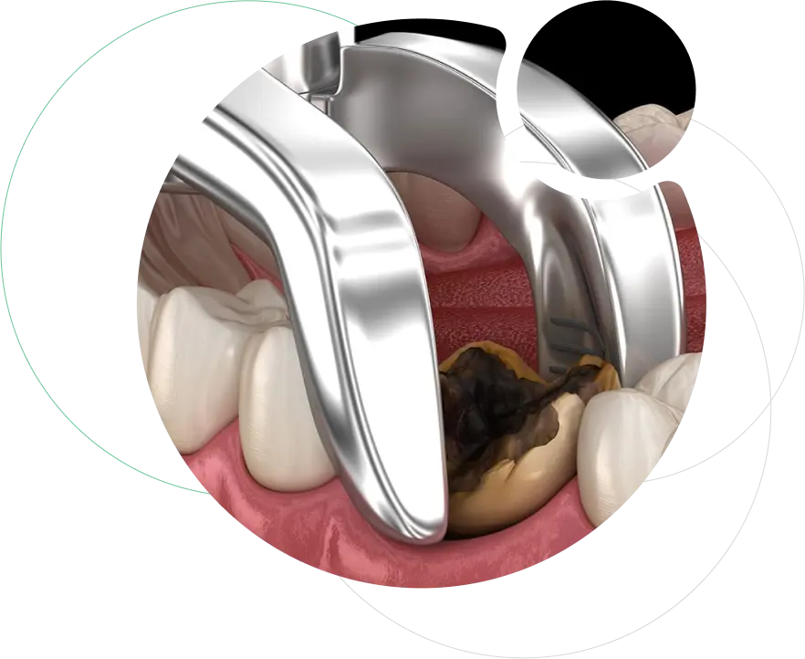 Tooth Extraction