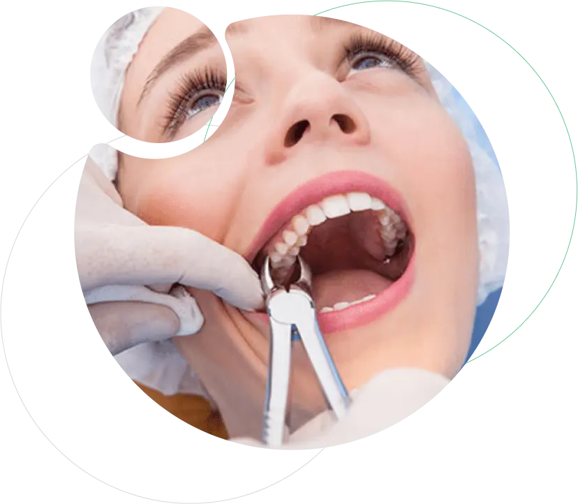 Tooth Extraction