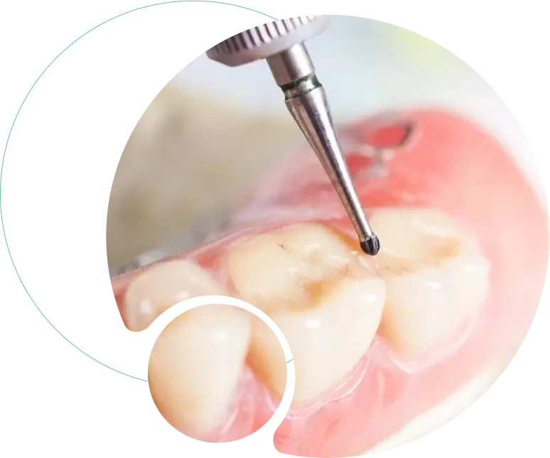 Esthetic Dental Filling