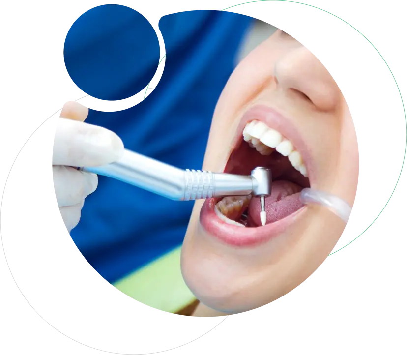 Esthetic Dental Filling