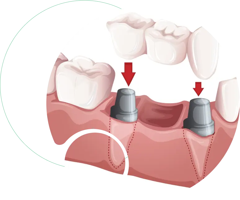 Fixed Crowns and Bridges