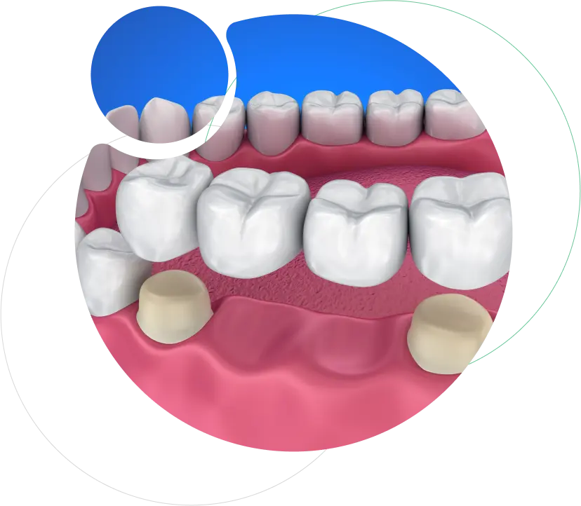 Fixed Crowns and Bridges