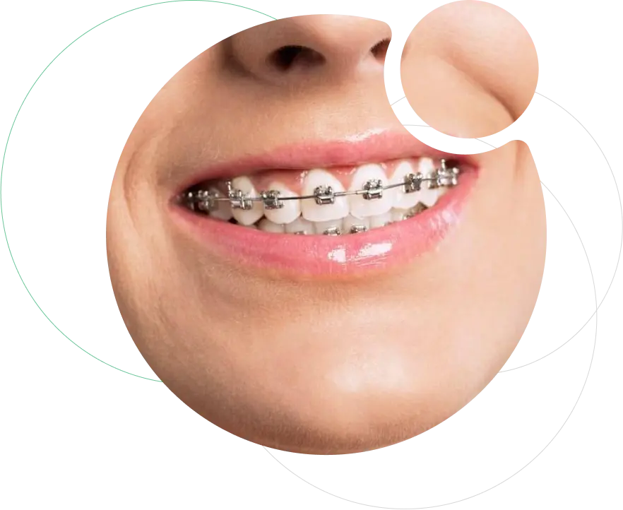 Fixed Orthodontic Treatment