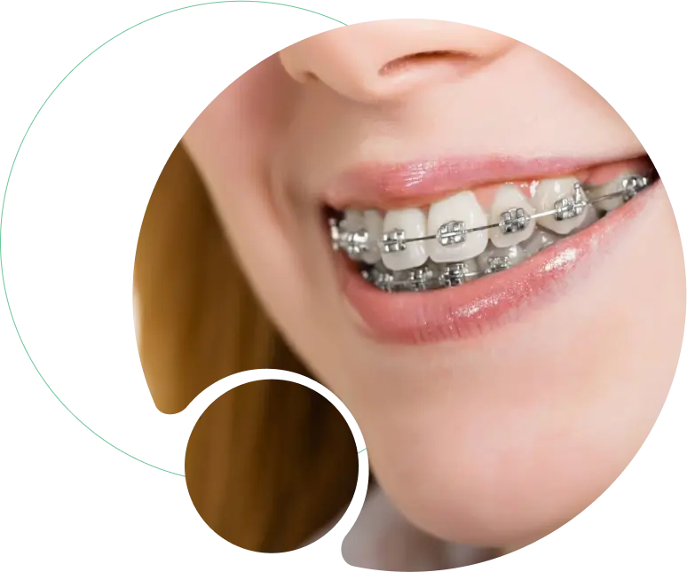 Fixed Orthodontic Treatment