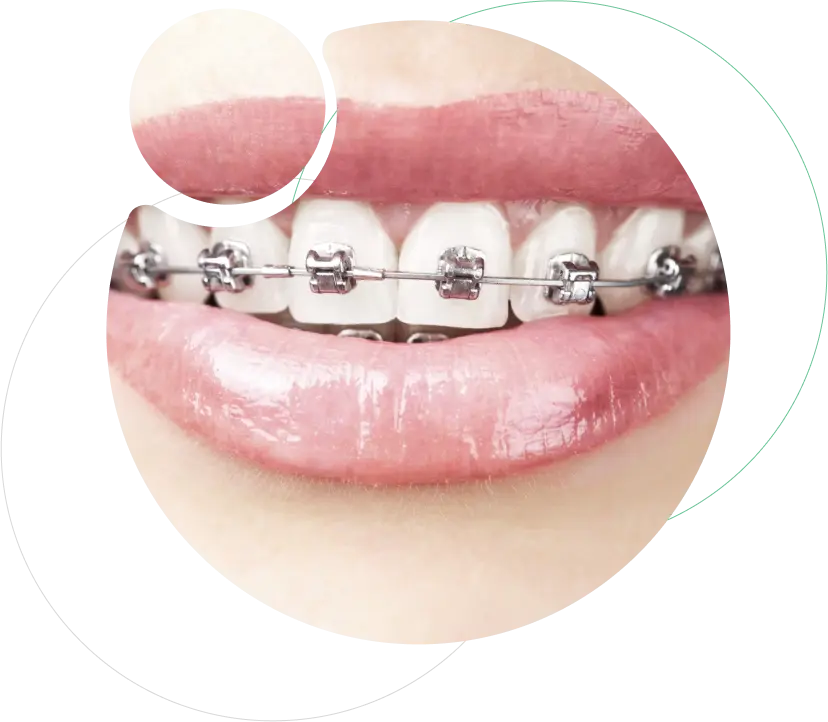 Fixed Orthodontic Treatment