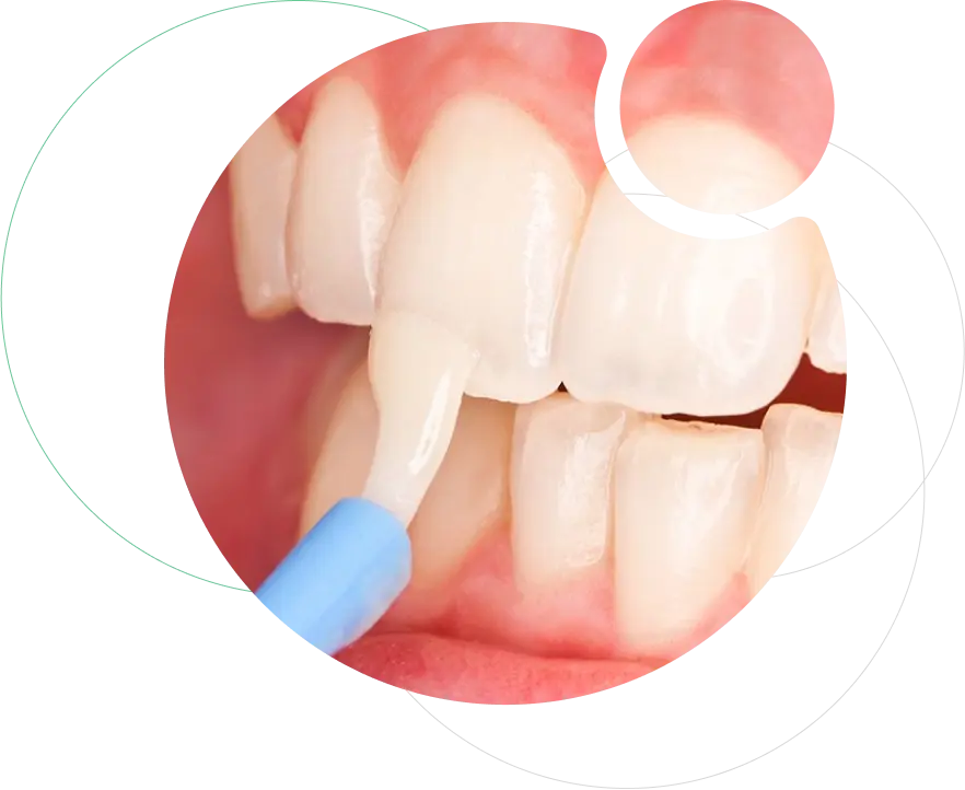 Fluoride Releasing GIC