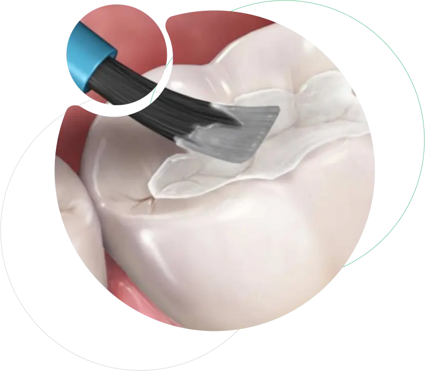 Fluoride Releasing GIC