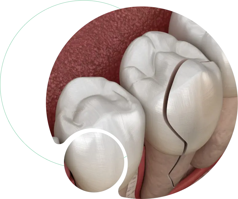 Fractured Front Tooth Build-Up