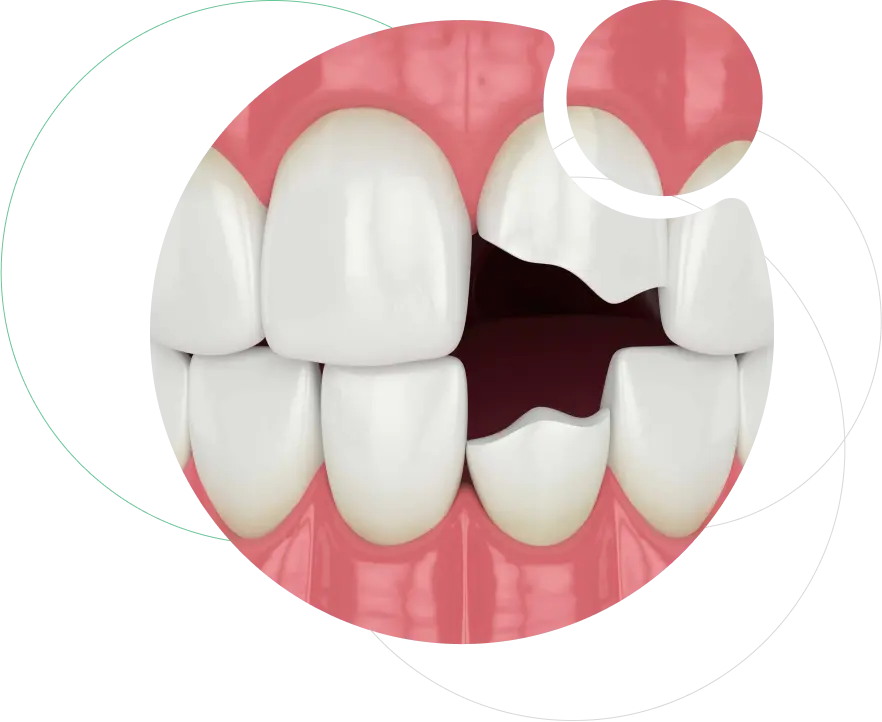 Fractured Front Tooth Build-Up