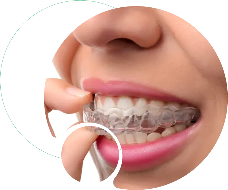 Invisalign Treatment