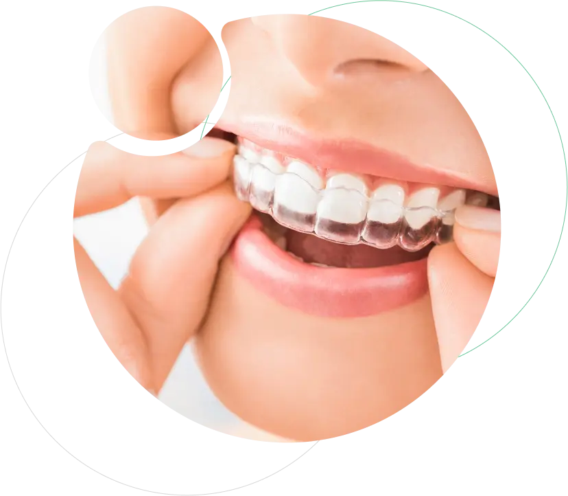 Invisalign Treatment