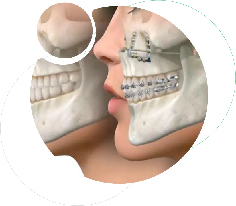 Jaw Deformity Correction