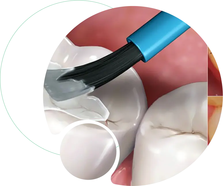 Pit and fissure sealents