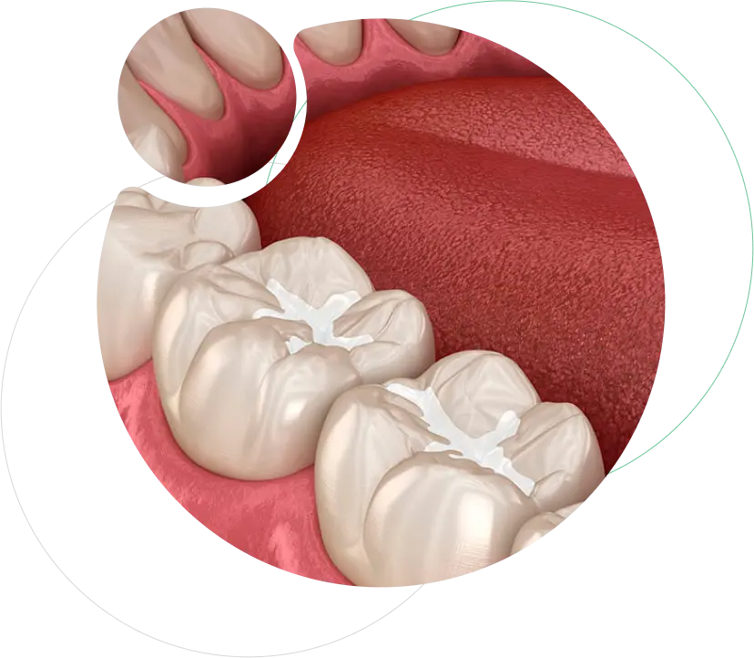 Pit and fissure sealents