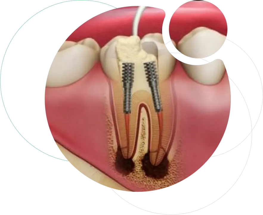 Post and Core