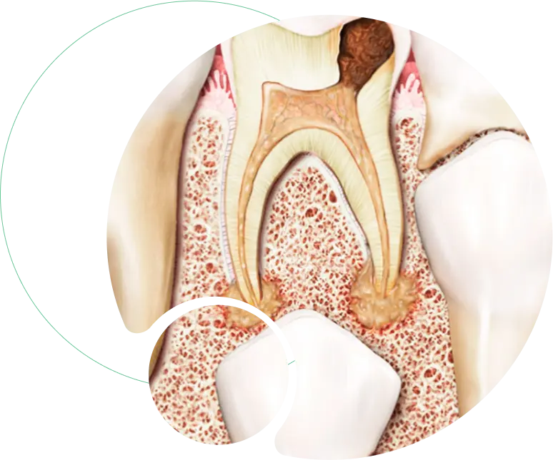 Pulpectomy