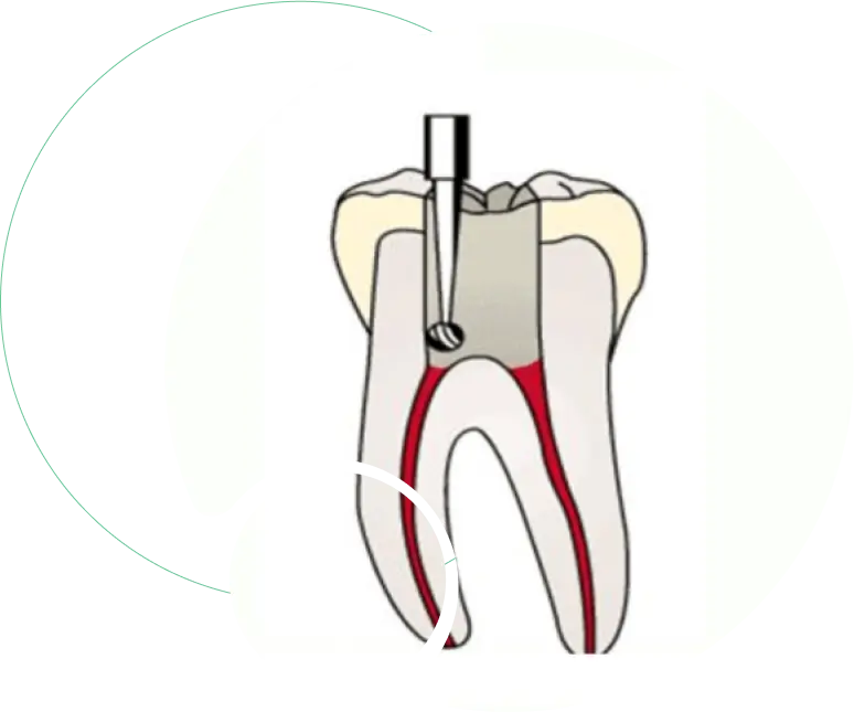 Pulpotomy