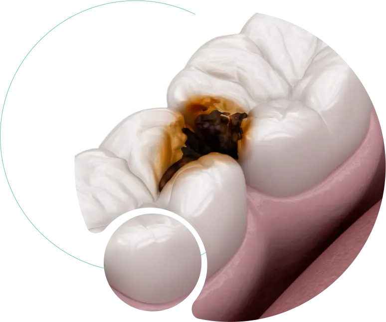 Deep Caries Management