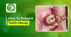 how to prevent tooth decay